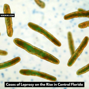Leprosy on the Rise in Central Florida